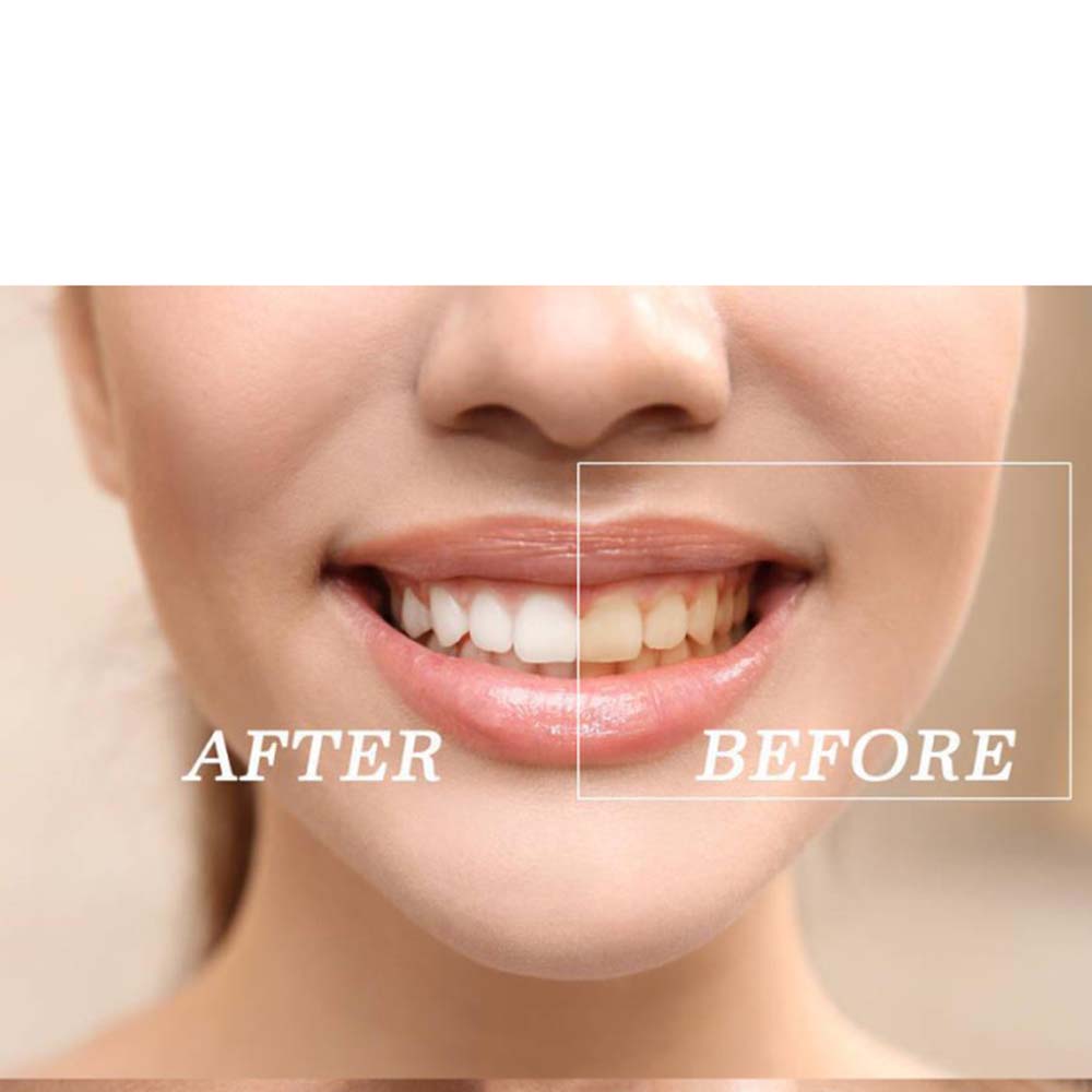 Высокое качество пероксид отбе – обзор и цена Teeth Whitening Light Kit