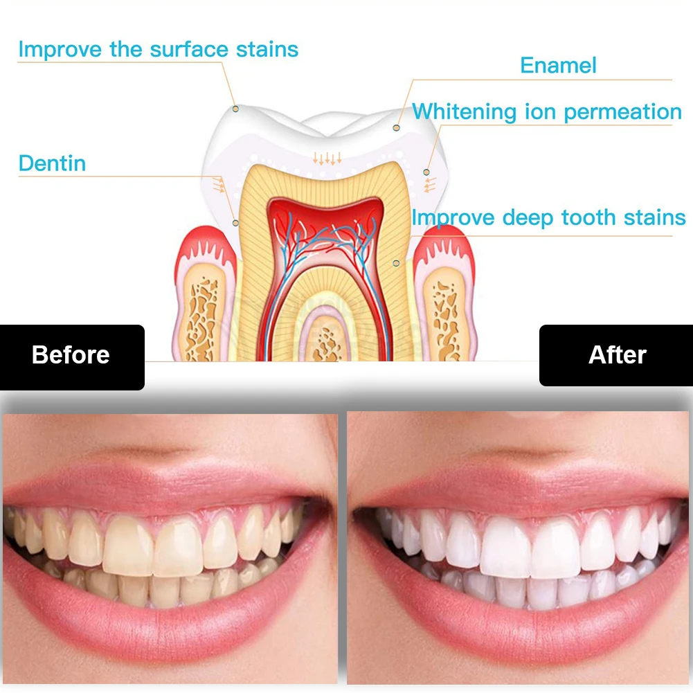 Набор для отбеливания зубов, м – обзор и цена Teeth Whitening Light Kit
